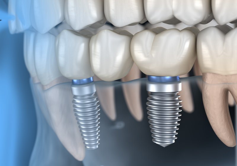 Rodzaje Implantów