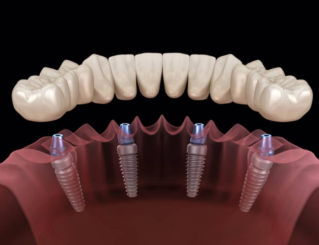 Rodzaje implantów