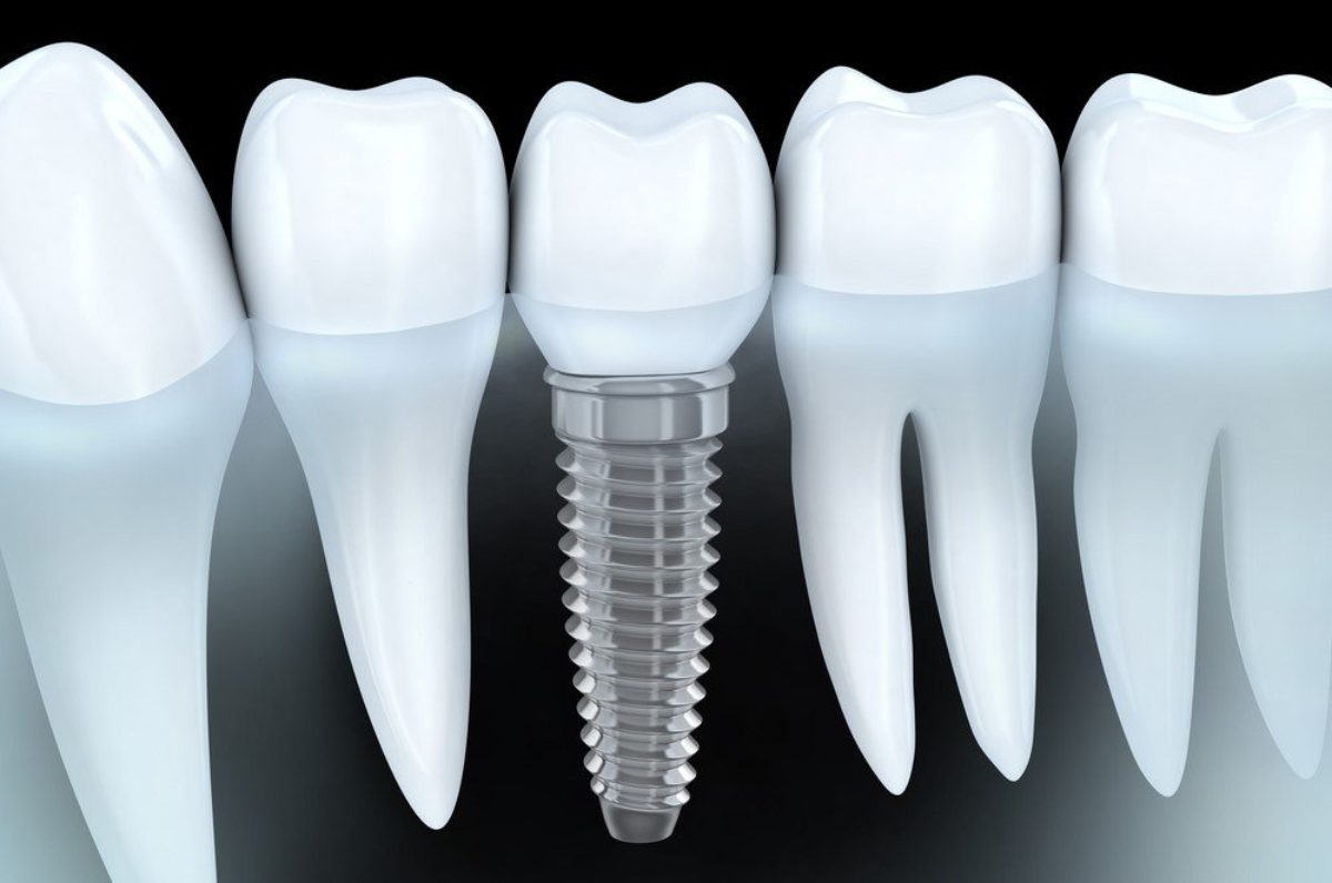 Zalety i wady implantów