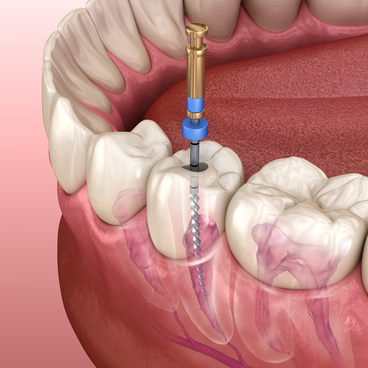 endodoncja jako przygotowanie do implantacji