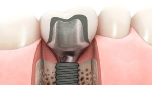 Implantacja natychmiastowa - kiedy warto się na nią zdecydować?