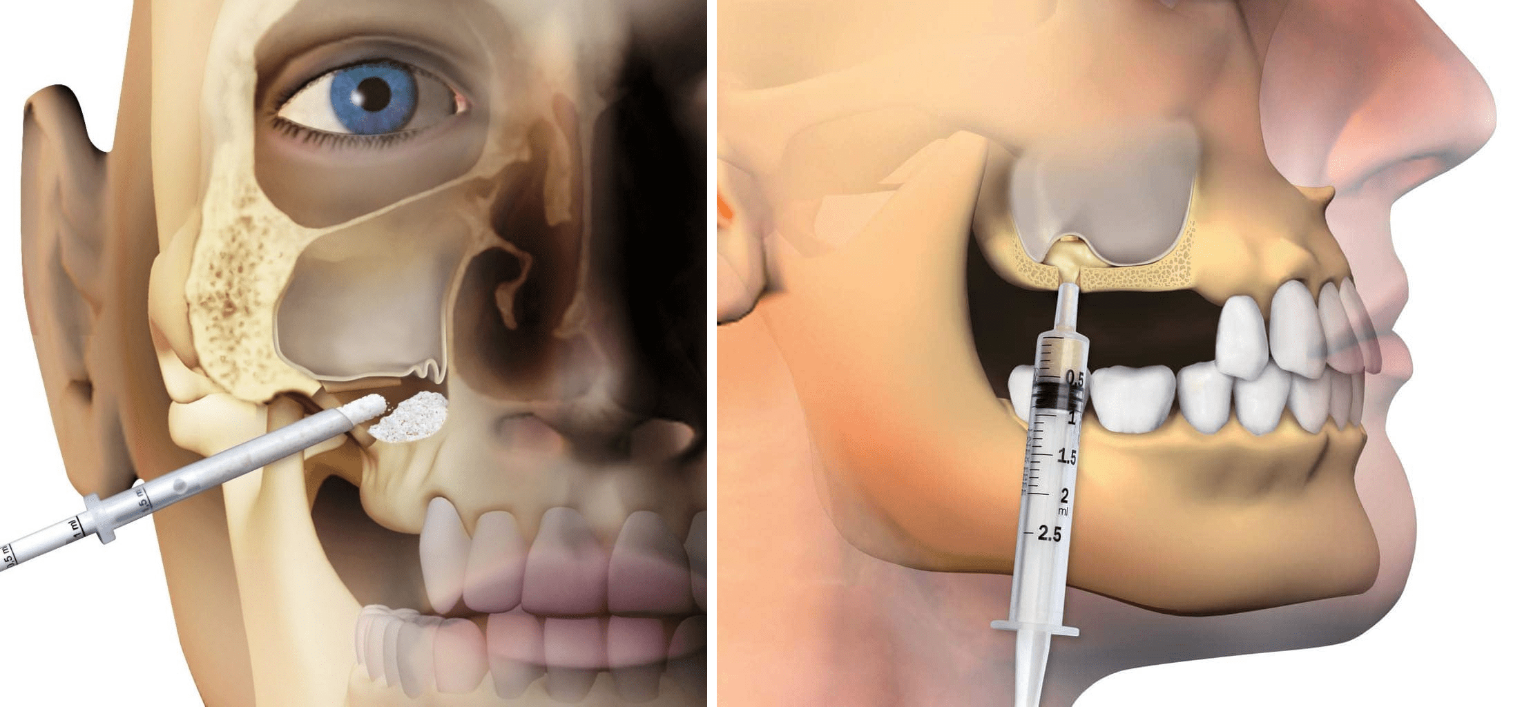 Zabieg podniesienia dna zatoki szczękowej przed procedurą implantacji