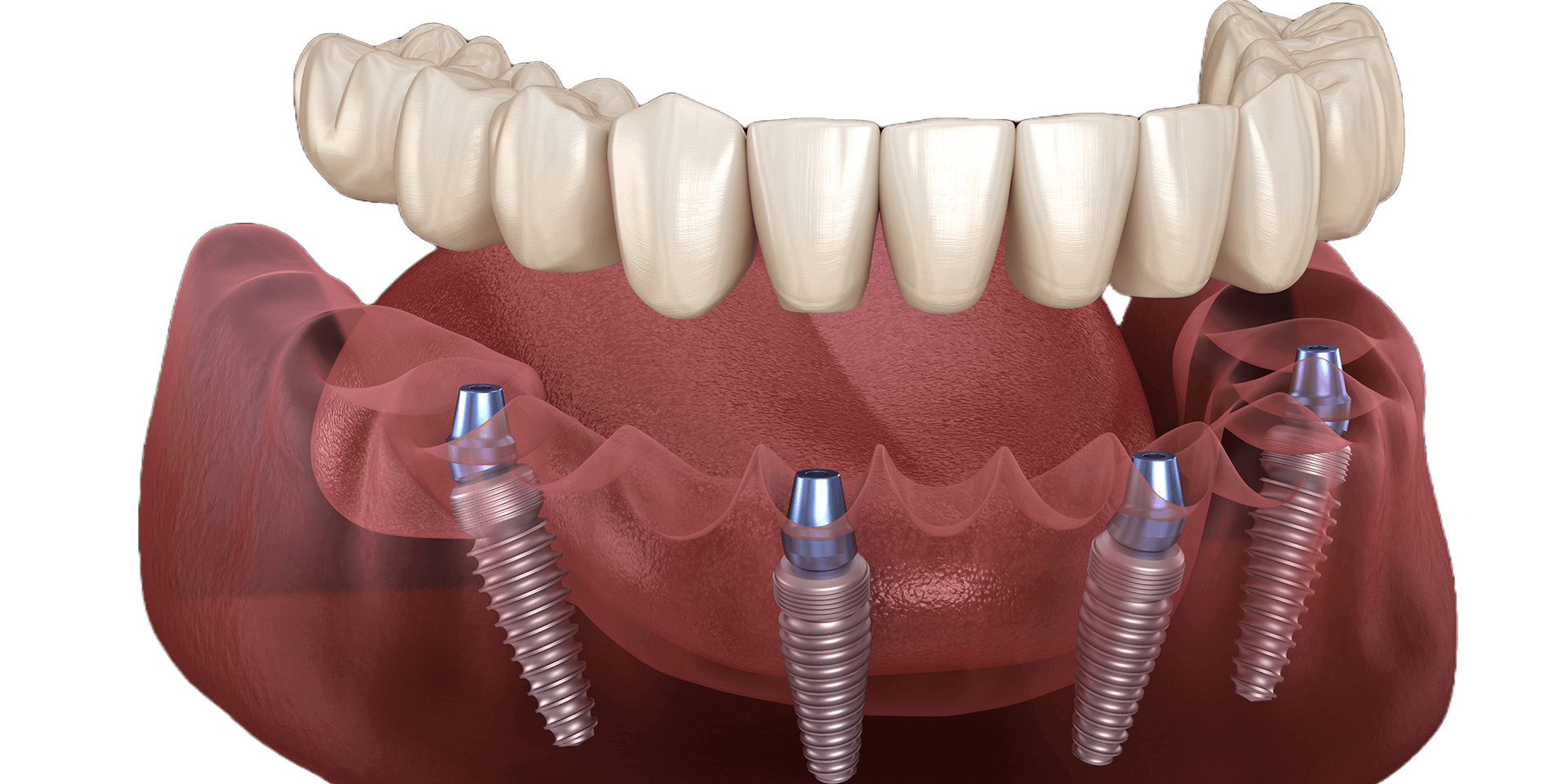 All-on-4 - jedna z metod implantacji