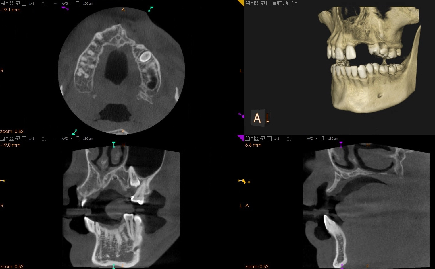 Augmentacja kości, odbudowa kości pod implantację