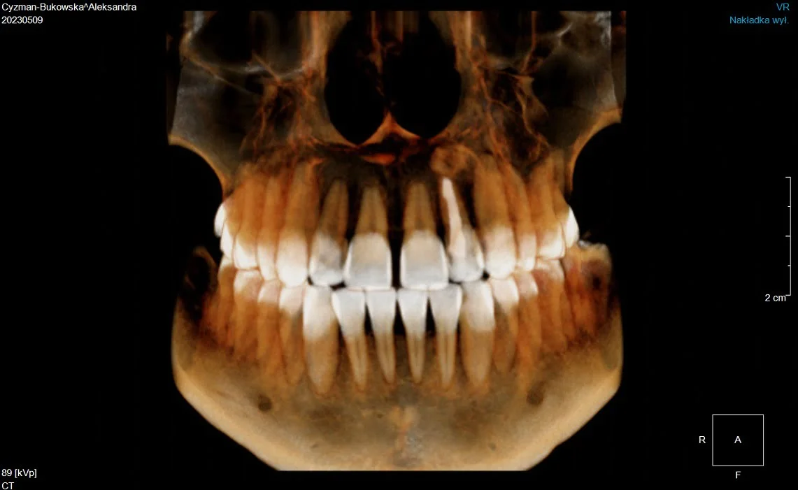 Zastosowanie technologii CBCT w planowaniu zabiegów chirurgicznych