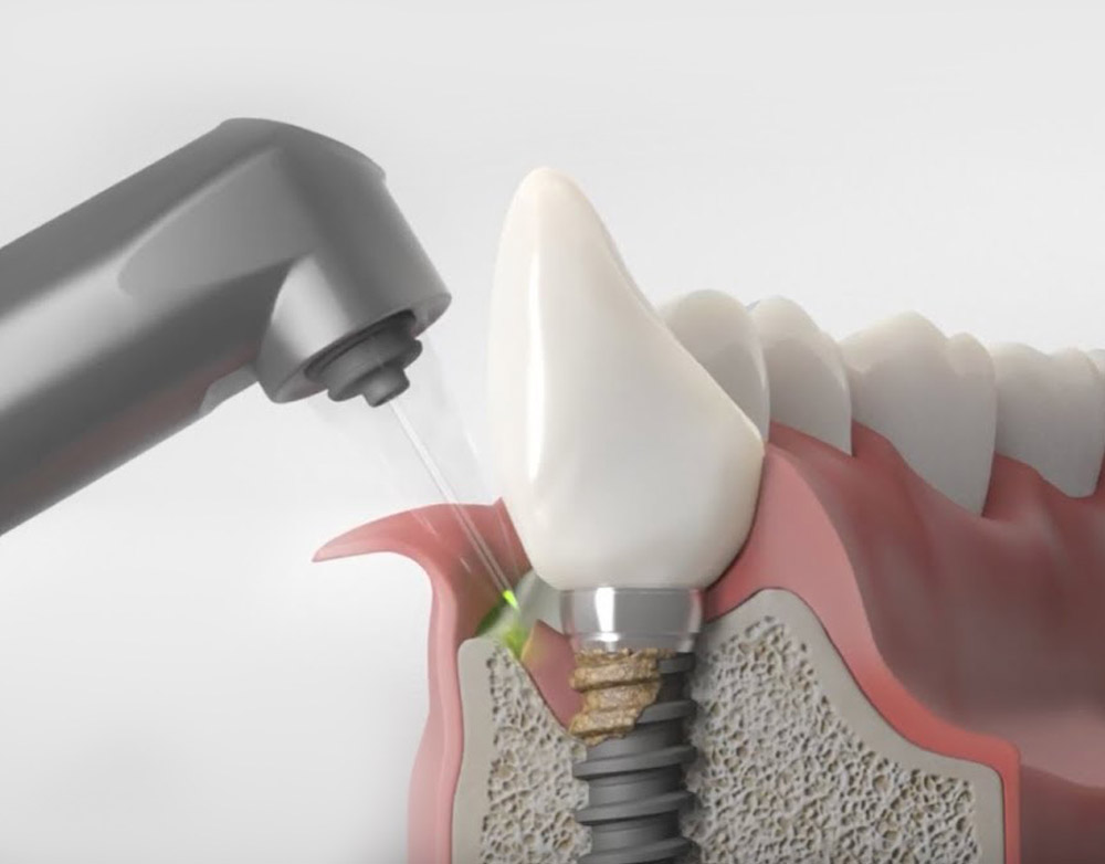 Periimplantitis – co to jest i jak temu zapobiec?